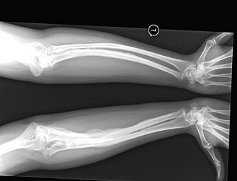 Raio X de pernas de criança  com doença dos ossos de vidro