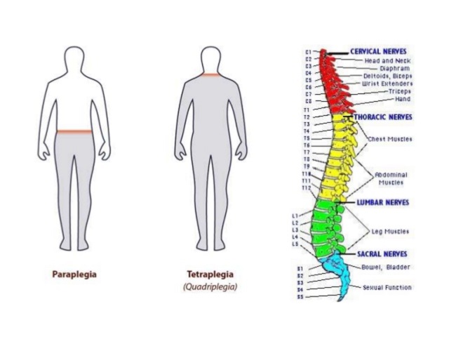 paraplegia e tetraplegia