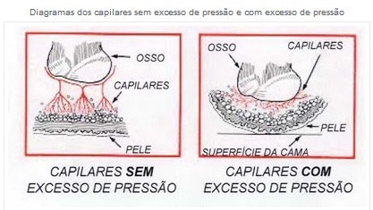 Escaras: informações