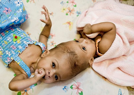 Nascidas em Cartum, no Sudão, as gêmeas siamesas Rital e Ritag Gaboura, de 11 meses, foram separadas em Londres