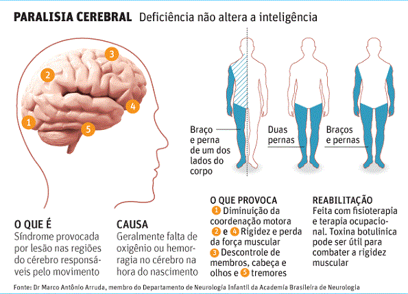 sobre paralisia cerebral