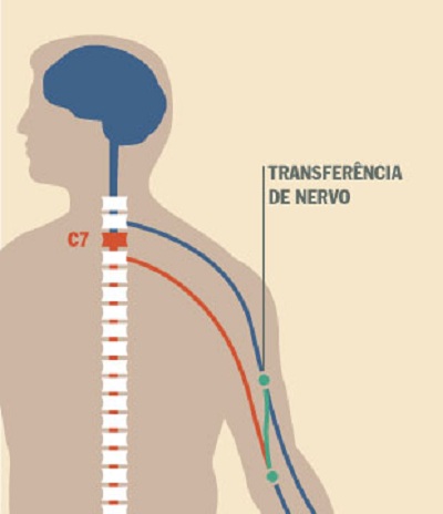 Imagem sobre a transferência de nervo