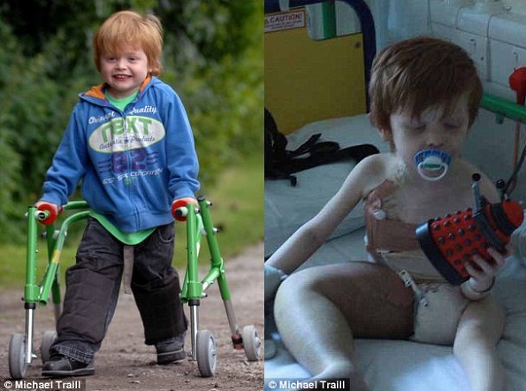 Alfie Milne está agora caminhando depois que um medicamento experimental fez com que o tumor parasse de cresce em seu corpo. Ele foi diagnosticado com uma doença linfática rara no Great Ormond Street Hospital, em 2010 (à direita) (Foto/ Reprodução: Daily Mail