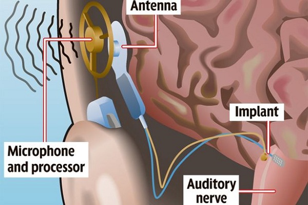 mplante de ouvido biônico