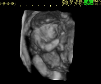 Ultrassom de feto anencéfalo| Imagem: Divulgação