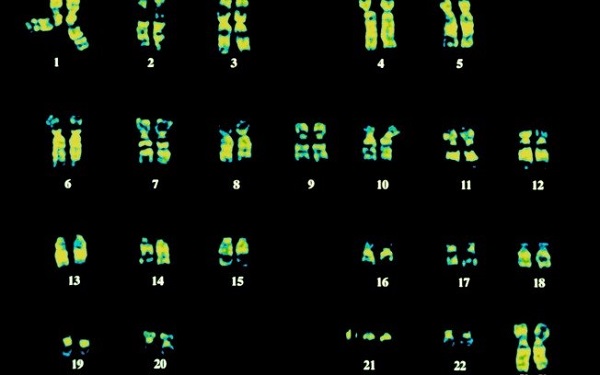 Cariótipo de uma paciente com síndrome de Down, que mostra os três cromossomos 21