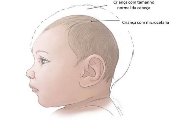 Tamanho da cabeça de um bebê normal e de um com microcefalia.