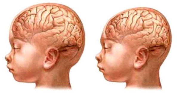 Ilustração da esquerda mostra criança com tamanha normal de cabeça. À direita, criança com microcefalia Foto: Divulgação