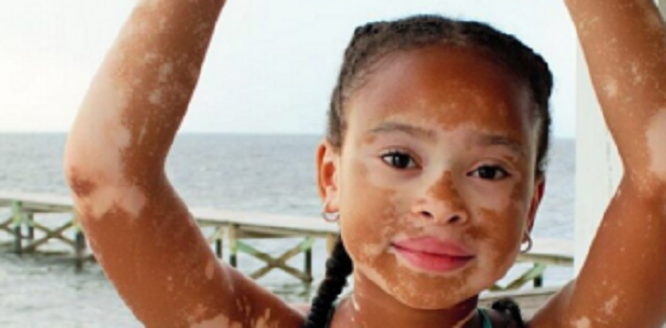 garota com vitiligo