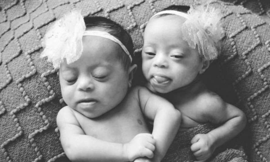 Bebês gêmeas com Síndrome de Down (Foto: Laura Duggleby Photography)